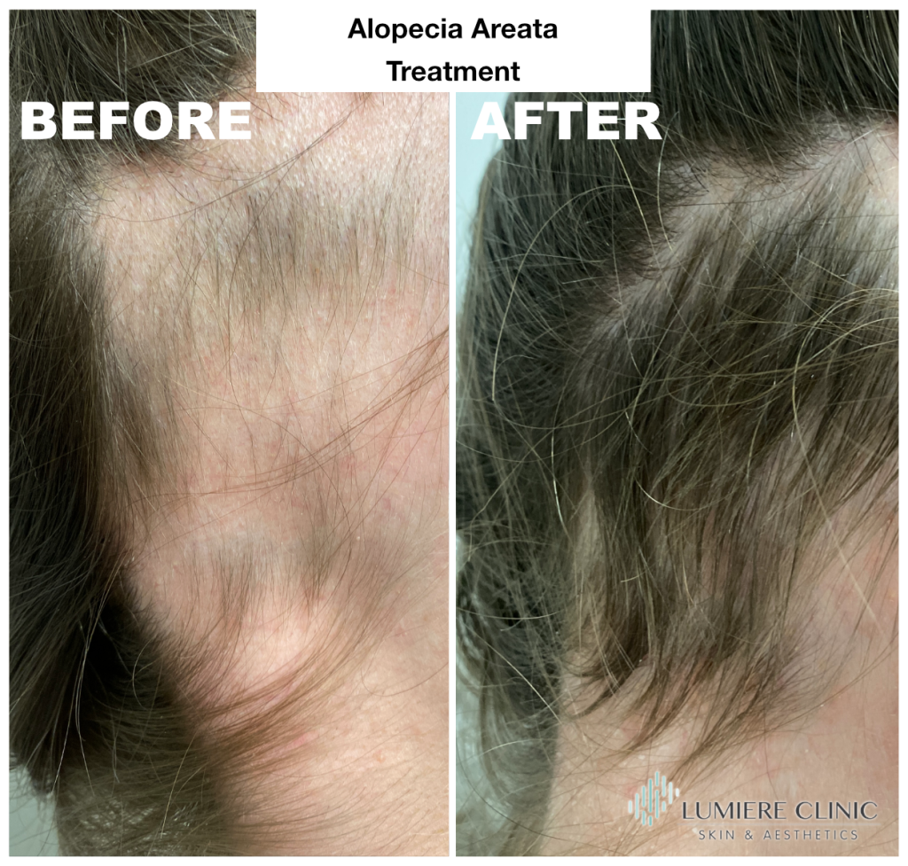 Alopeciabeforeandafter Copy Lumiere Clinic